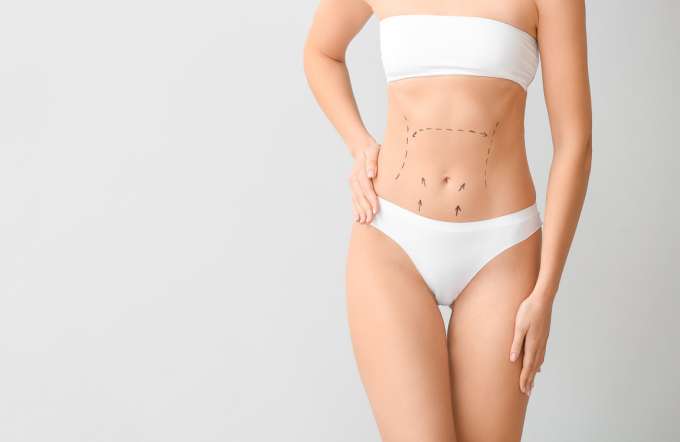 Abdominoplastia (FILEminimizer)